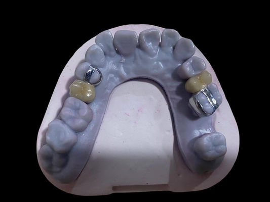شراء التاج الأسنان PFM الدقيق للغاية سبيكة Ni الفولاذ الحر الفورسلين التصنيع عبر الإنترنت
