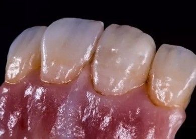 الألمانية Amanjilbach Zirconia تاج أسنان كثافة عالية مع تخصيص