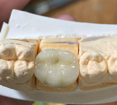 الدقة الجمالية الأسنان القوية PFM البورسلين المصبوب إلى التاج المعدني في طب الأسنان